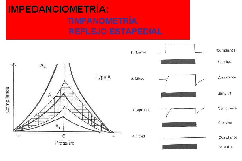 IMPEDANCIOMETRÍA: TIMPANOMETRÍA REFLEJO ESTAPEDIAL 