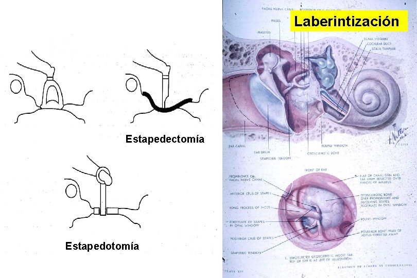 Laberintización Estapedectomía Estapedotomía 