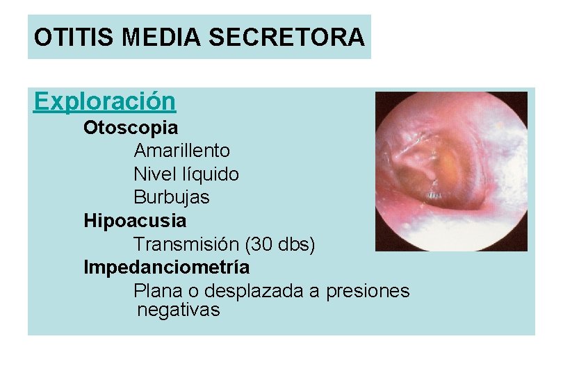OTITIS MEDIA SECRETORA Exploración Otoscopia Amarillento Nivel líquido Burbujas Hipoacusia Transmisión (30 dbs) Impedanciometría