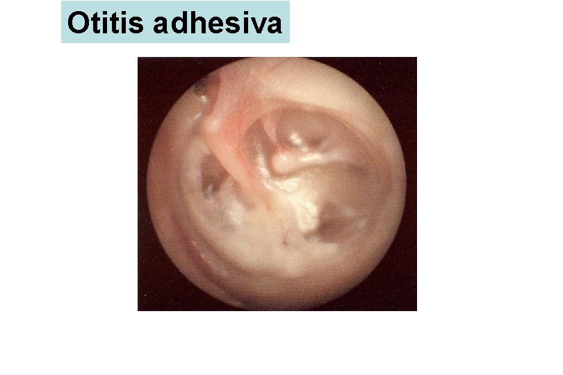 Otitis adhesiva 
