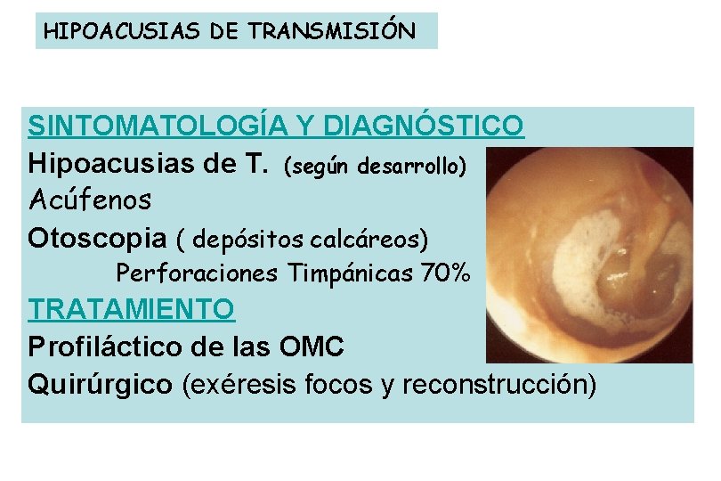 HIPOACUSIAS DE TRANSMISIÓN SINTOMATOLOGÍA Y DIAGNÓSTICO Hipoacusias de T. (según desarrollo) Acúfenos Otoscopia (