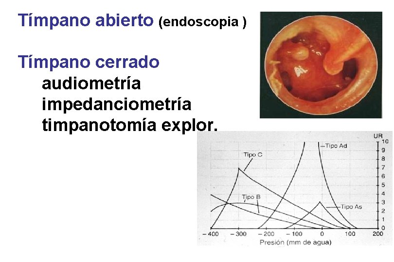Tímpano abierto (endoscopia ) Tímpano cerrado audiometría impedanciometría timpanotomía explor. 