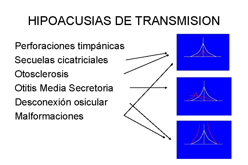 HIPOACUSIAS DE TRANSMISION Perforaciones timpánicas Secuelas cicatriciales Otosclerosis Otitis Media Secretoria Desconexión osicular Malformaciones