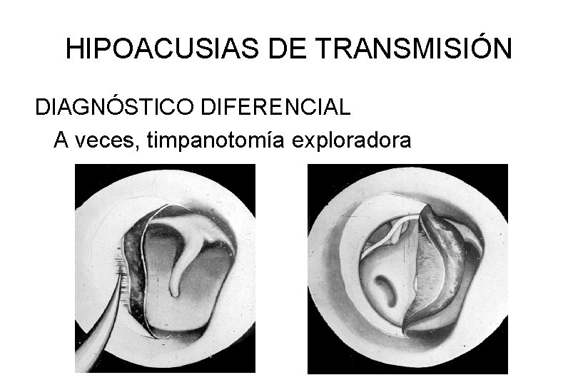 HIPOACUSIAS DE TRANSMISIÓN DIAGNÓSTICO DIFERENCIAL A veces, timpanotomía exploradora 
