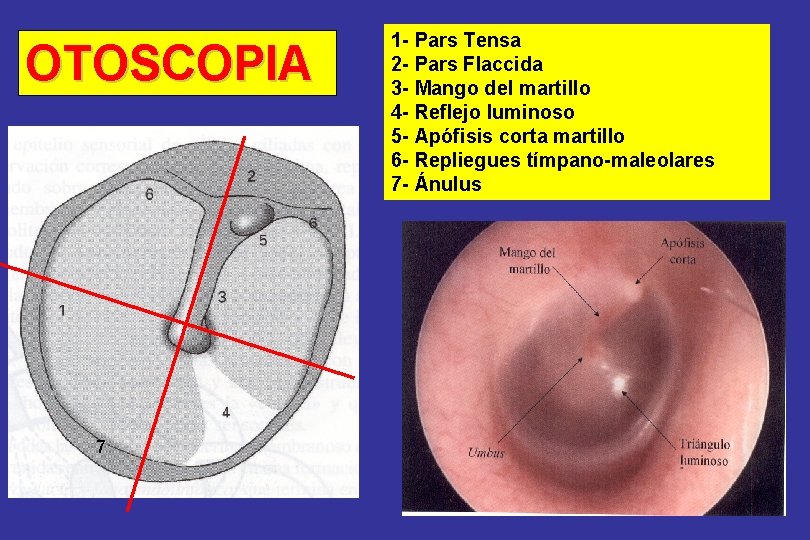 OTOSCOPIA 7 1 - Pars Tensa 2 - Pars Flaccida 3 - Mango del