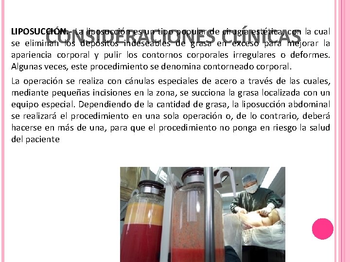 CONSIDERACIONES CLÍNICAS LIPOSUCCIÓN. - La liposucción es un tipo popular de cirugía estética, con