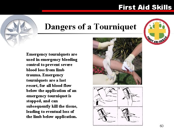 First Aid Skills Dangers of a Tourniquet Emergency tourniquets are used in emergency bleeding