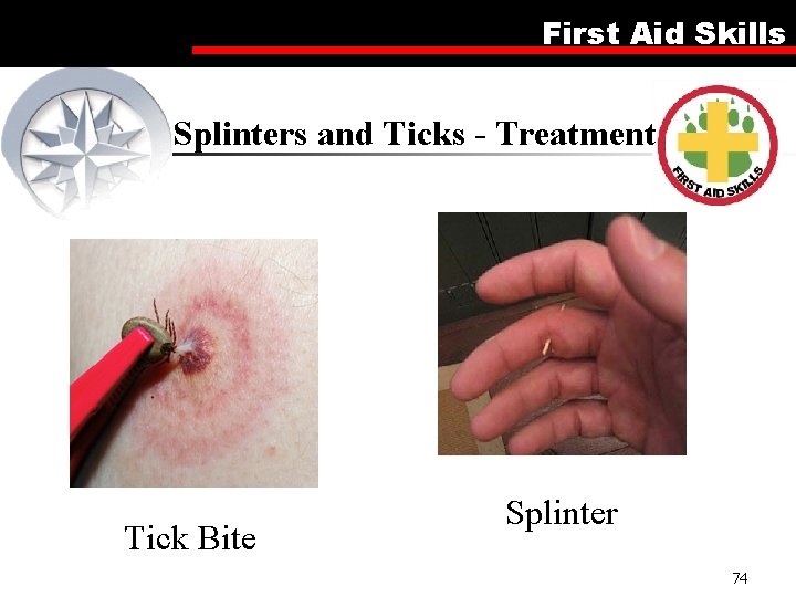 First Aid Skills Splinters and Ticks - Treatment Tick Bite Splinter 74 