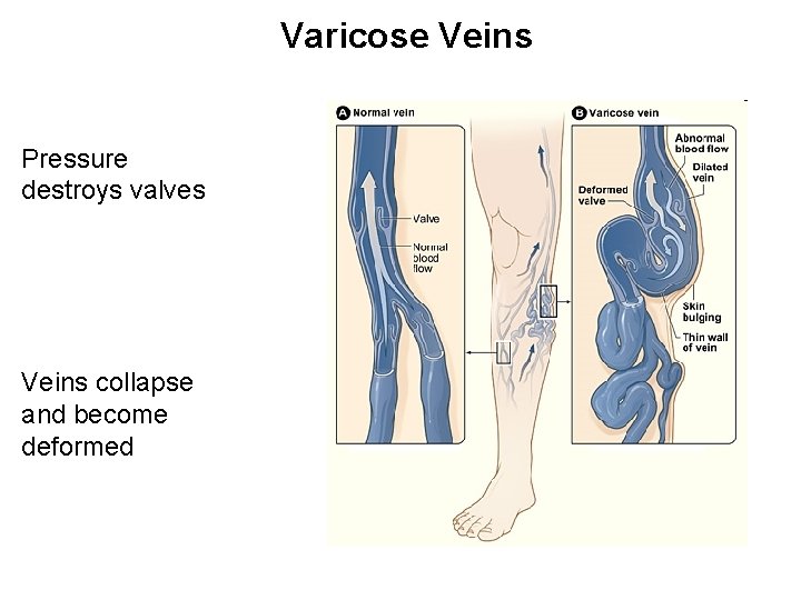Varicose Veins Pressure destroys valves Veins collapse and become deformed 