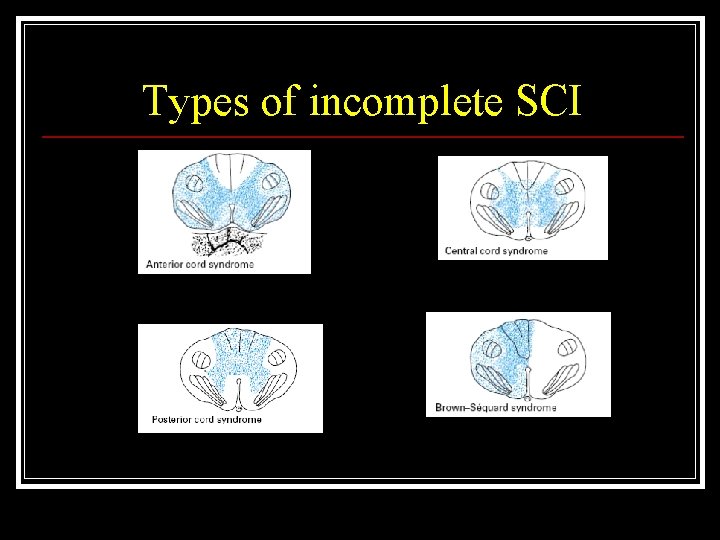 Types of incomplete SCI 