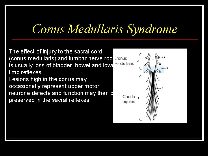 Conus Medullaris Syndrome The effect of injury to the sacral cord (conus medullaris) and