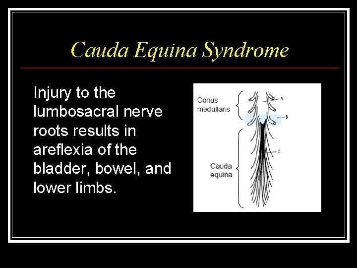 Cauda Equina Syndrome Injury to the lumbosacral nerve roots results in areflexia of the