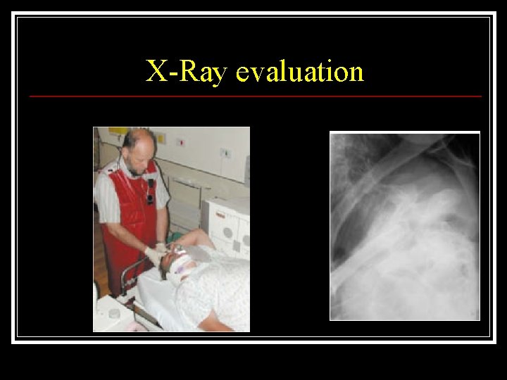 X-Ray evaluation 