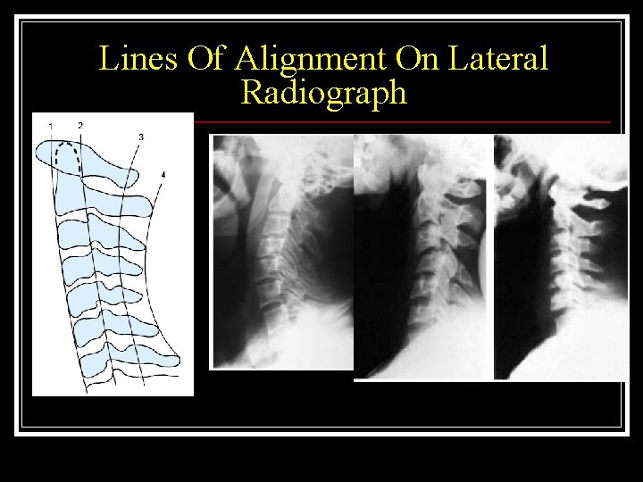 Lines Of Alignment On Lateral Radiograph 