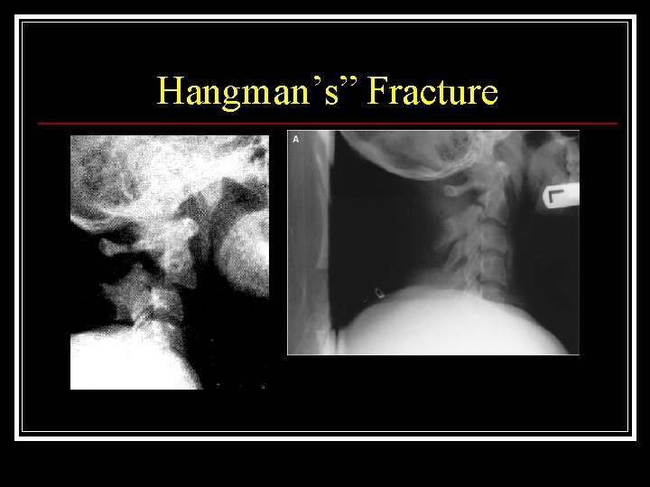 Hangman’s” Fracture 