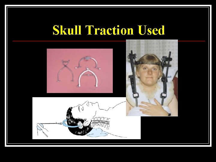 Skull Traction Used 