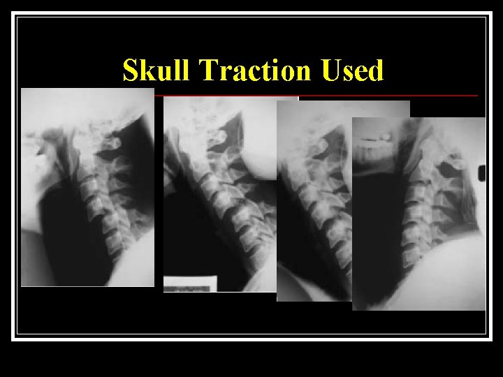 Skull Traction Used 