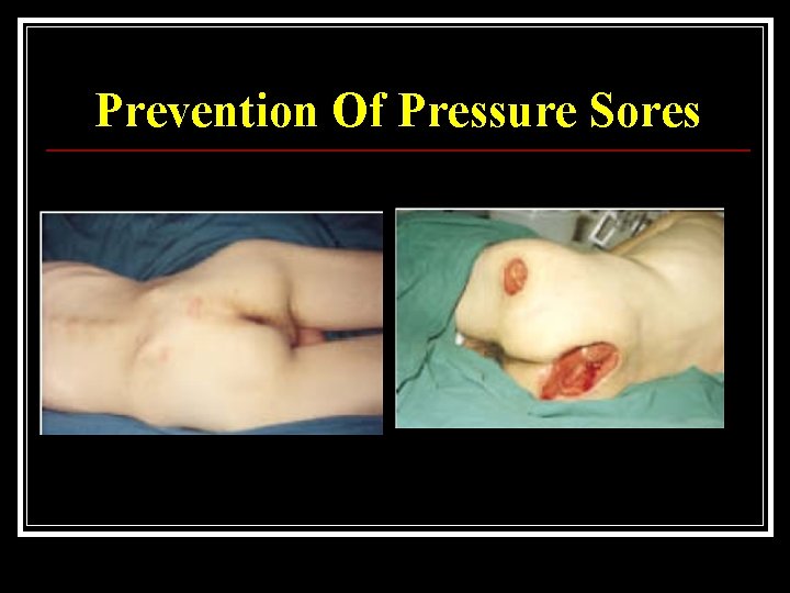 Prevention Of Pressure Sores 