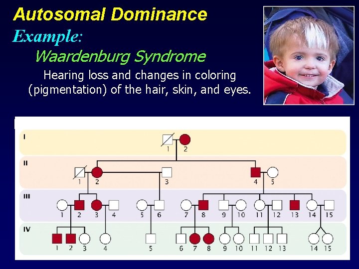 Autosomal Dominance Example: Waardenburg Syndrome Hearing loss and changes in coloring (pigmentation) of the