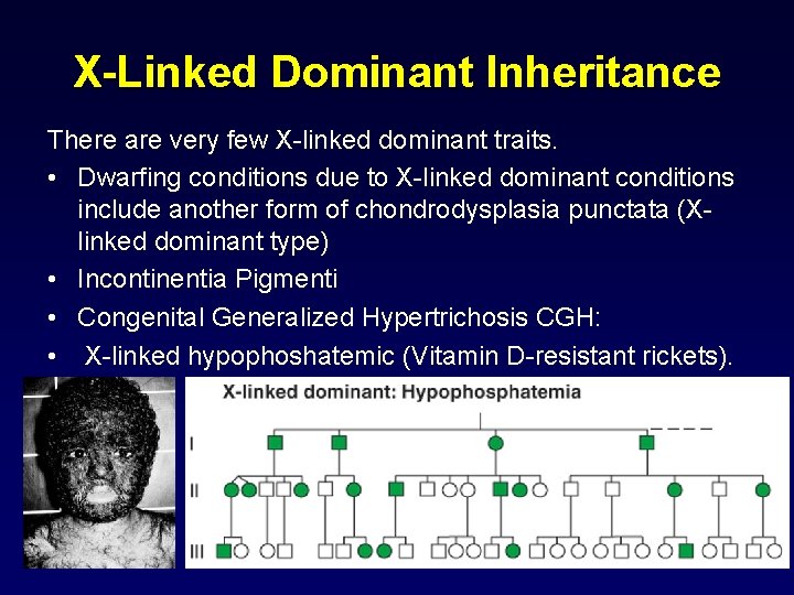 X-Linked Dominant Inheritance There are very few X-linked dominant traits. • Dwarfing conditions due