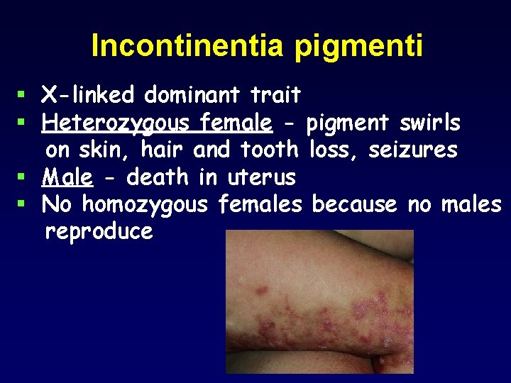 Incontinentia pigmenti § X-linked dominant trait § Heterozygous female - pigment swirls on skin,