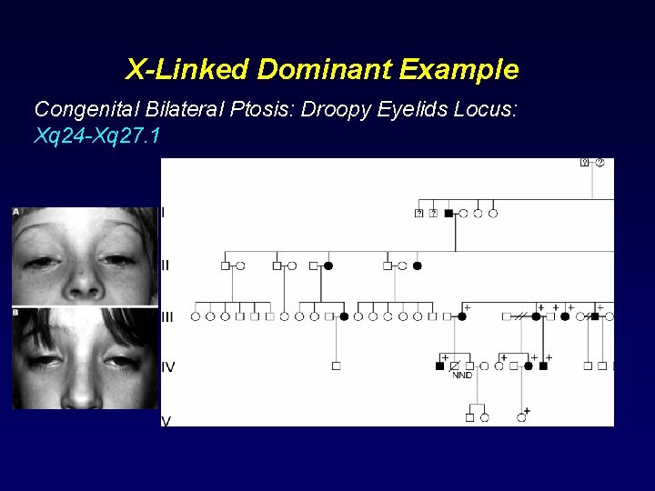 X-Linked Dominant Example Congenital Bilateral Ptosis: Droopy Eyelids Locus: Xq 24 -Xq 27. 1