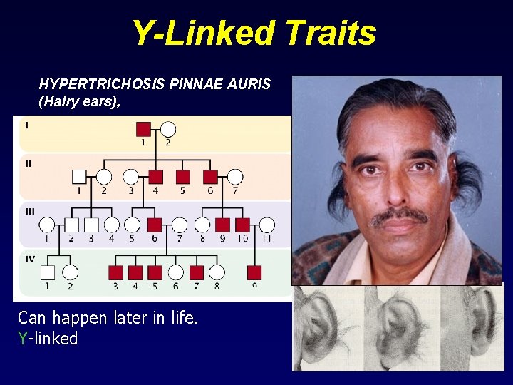 Y-Linked Traits HYPERTRICHOSIS PINNAE AURIS (Hairy ears), Can happen later in life. Y-linked 