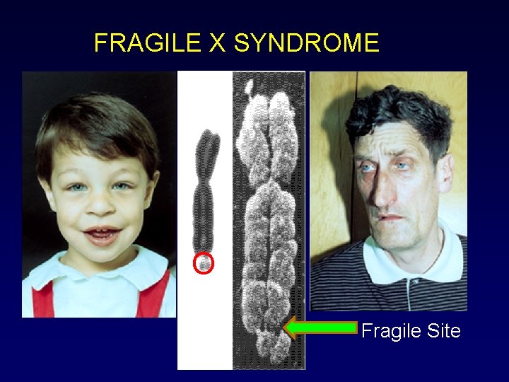 FRAGILE X SYNDROME O Fragile Site 