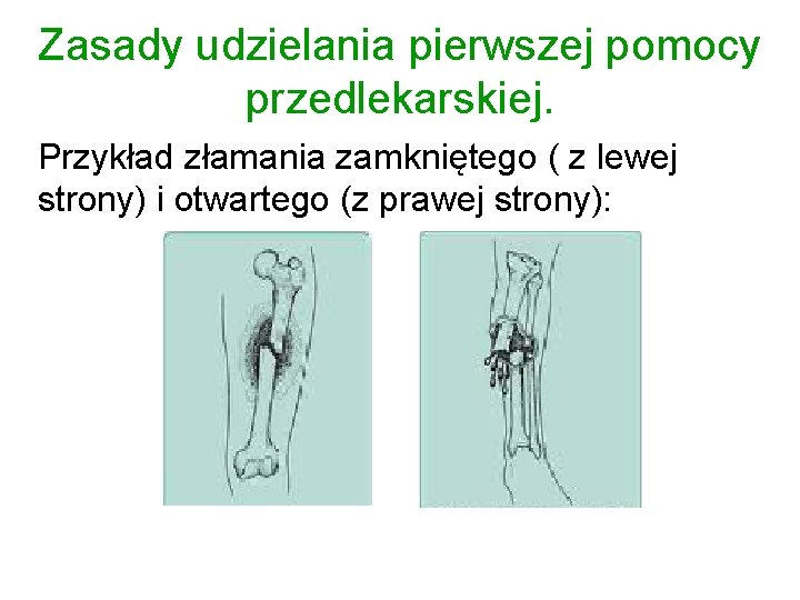 Zasady udzielania pierwszej pomocy przedlekarskiej. Przykład złamania zamkniętego ( z lewej strony) i otwartego