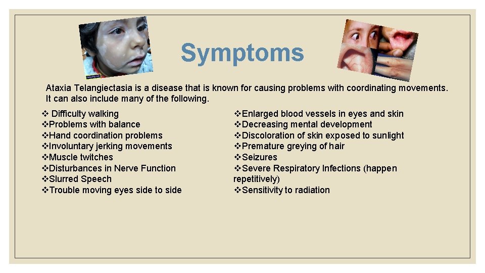 Symptoms Ataxia Telangiectasia is a disease that is known for causing problems with coordinating