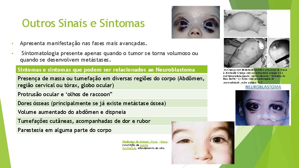 Outros Sinais e Sintomas • Apresenta manifestação nas fases mais avanc adas. • Sintomatologia