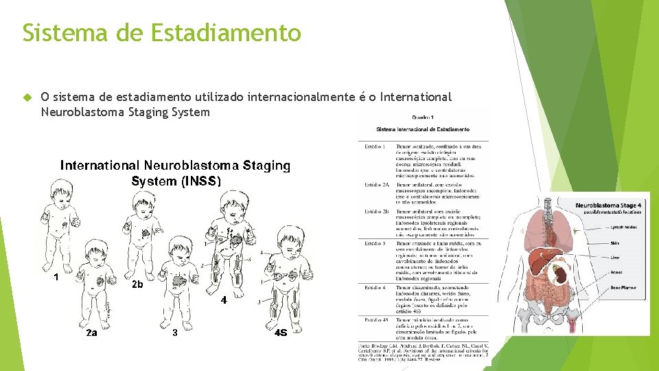 Sistema de Estadiamento O sistema de estadiamento utilizado internacionalmente é o International Neuroblastoma Staging