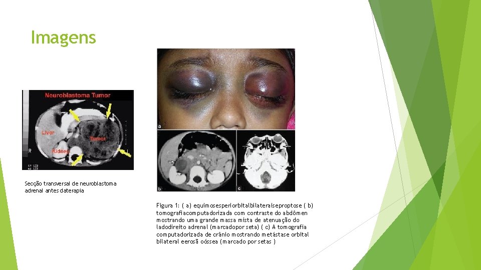 Imagens Secção transversal de neuroblastoma adrenal antes daterapia Figura 1: ( a) equimosesperiorbitalbilateraiseproptose (