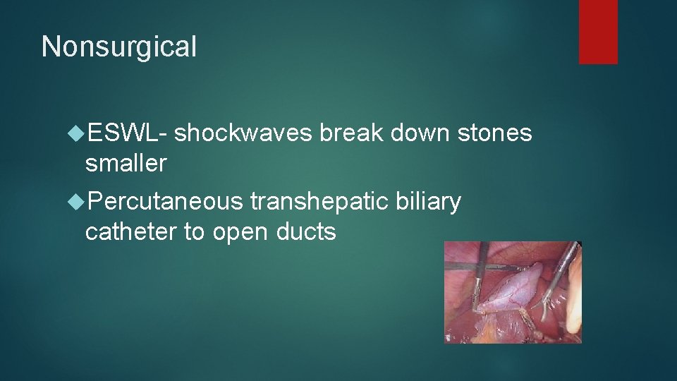 Nonsurgical ESWL- shockwaves break down stones smaller Percutaneous transhepatic biliary catheter to open ducts