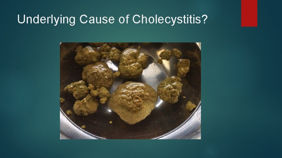 Underlying Cause of Cholecystitis? 