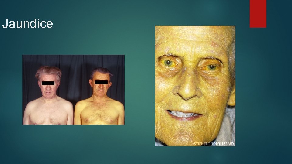 Jaundice 