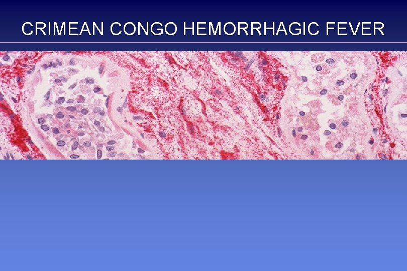 CRIMEAN CONGO HEMORRHAGIC FEVER 