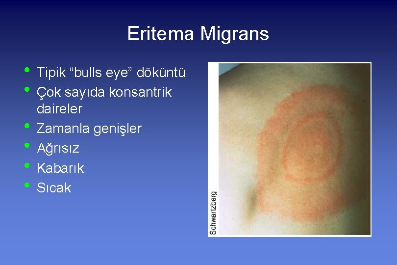 Eritema Migrans • Tipik “bulls eye” döküntü • Çok sayıda konsantrik • • daireler