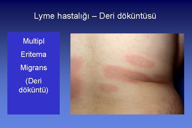 Lyme hastalığı – Deri döküntüsü Multipl Eritema Migrans (Deri döküntü) 