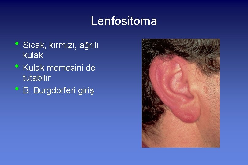 Lenfositoma • Sıcak, kırmızı, ağrılı • • kulak Kulak memesini de tutabilir B. Burgdorferi