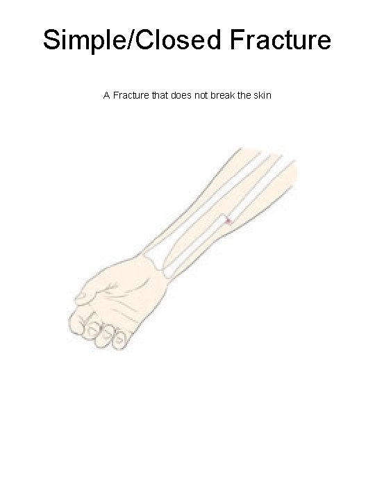 Simple/Closed Fracture A Fracture that does not break the skin 