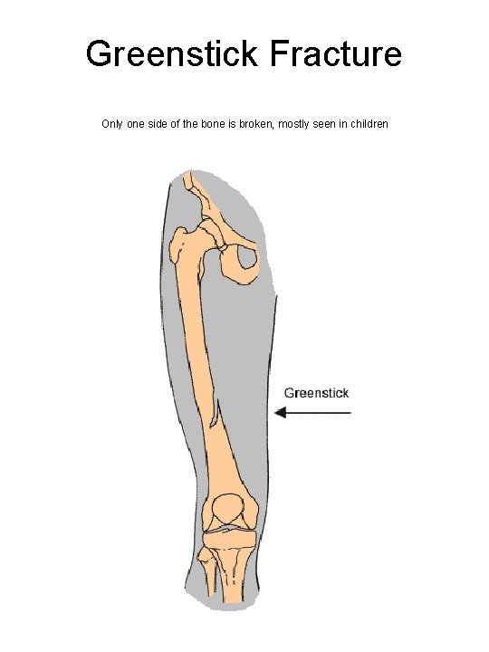 Greenstick Fracture Only one side of the bone is broken, mostly seen in children