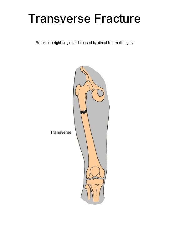 Transverse Fracture Break at a right angle and caused by direct traumatic injury 