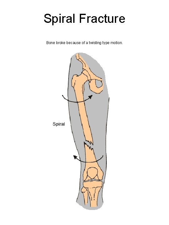 Spiral Fracture Bone broke because of a twisting type motion. 