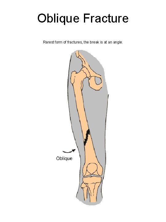 Oblique Fracture Rarest form of fractures, the break is at an angle. 