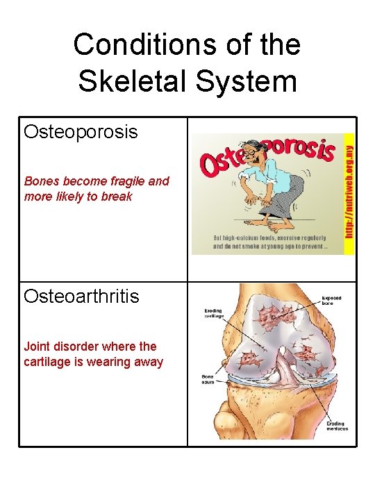 Conditions of the Skeletal System Osteoporosis Bones become fragile and more likely to break