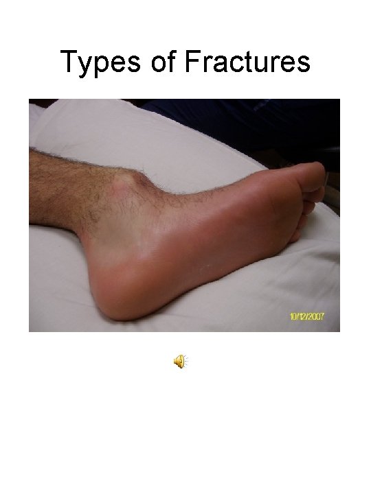Types of Fractures 