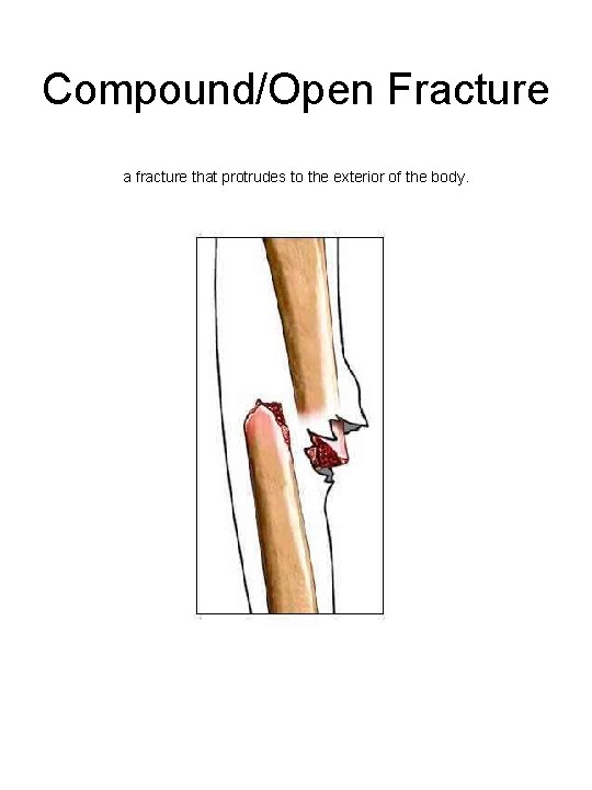 Compound/Open Fracture a fracture that protrudes to the exterior of the body. 