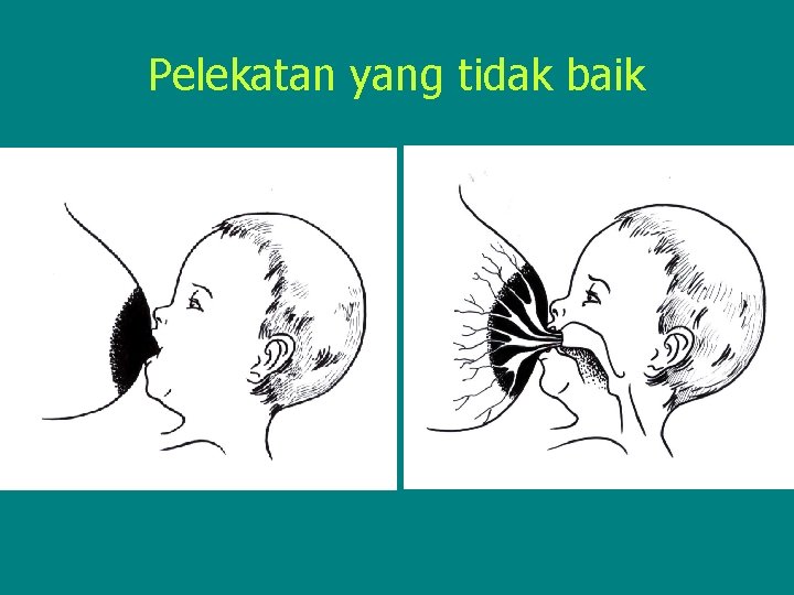 Pelekatan yang tidak baik 