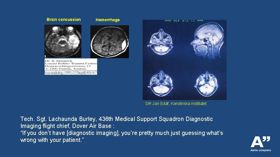 Brain concussion Hemorrhage DR Jan Sääf, Karolinska Institutet Tech. Sgt. Lachaunda Burley, 436 th